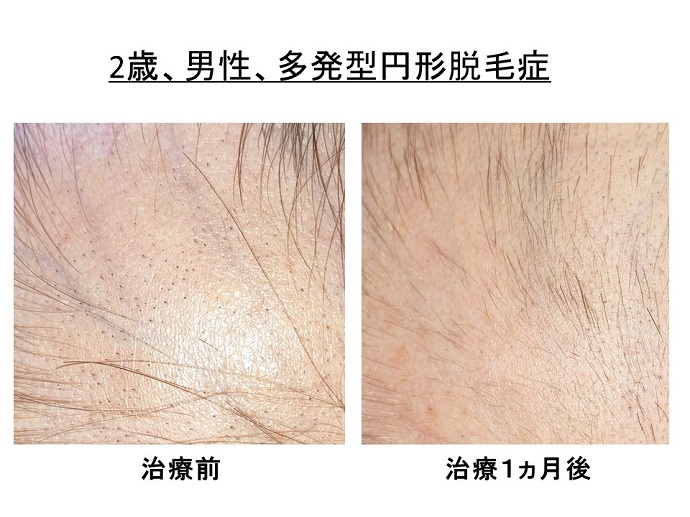円形脱毛症　病院